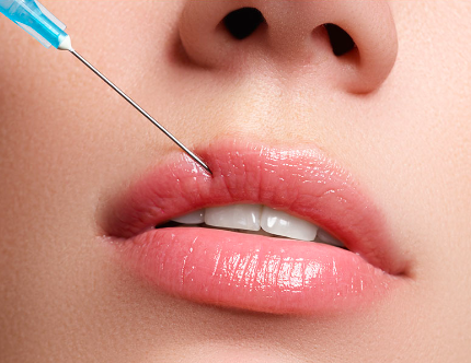 Acide hyaluronique : injection des lèvres